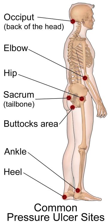 Areas where bed sores may show up.