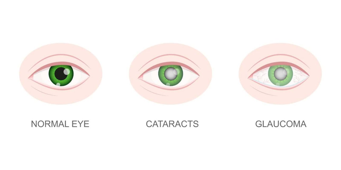 Difference between a healthy eyes vs. with cataract vs. with glaucoma.